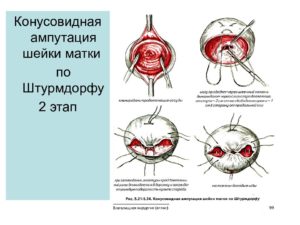 Ампутация шейки матки по штурмдорфу