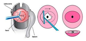 Радиоволновая биопсия шейки матки