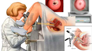 Почему кровит шейка матки при осмотре