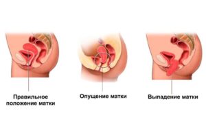 Признаки выпадения матки