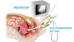 Узи шейки матки как делают