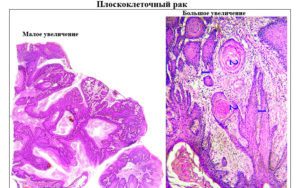 Плоскоклеточный ороговевающий рак шейки матки