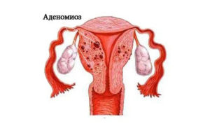 Является ли аденомиоз матки раком