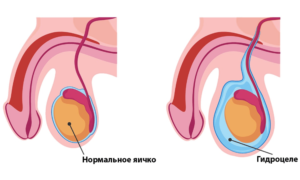 Гидроцеле осумкованное что это