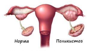 Увеличенные яичники у женщин причины