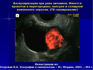 Злокачественные и доброкачественные опухоли яичников