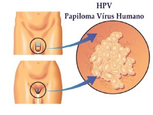 Hpv инфекция у женщин что это