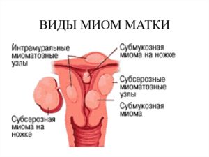 Интерстициально субсерозная миома матки что это такое