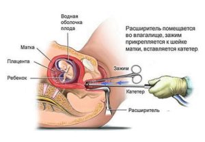 Половая жизнь после выскабливания