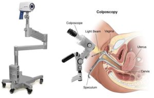 Кольпоскопия шейки матки