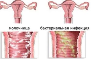 Бывает ли молочница у девственниц