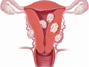 Узловая фибромиома матки
