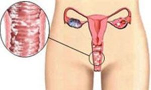 Причины вагинального кандидоза