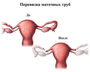 Как перевязывают маточные трубы