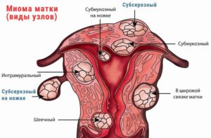 Субсерозная лейомиома матки