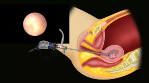 Как проводится гистероскопия эндометрия