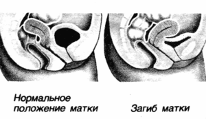 Упражнения при загибе матки кзади