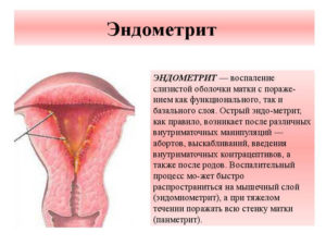 Симптомы воспаления матки