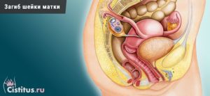 Причины, симптомы и лечение загиба шейки матки