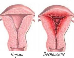 Воспаление матки после родов симптомы