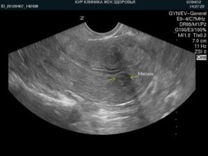 Когда делать УЗИ при миоме матки