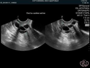 Лечение кисты в матке
