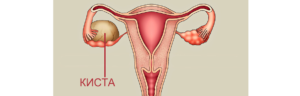 Чем лечить кисту яичника медикаментозно