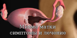 Симптомы миомы матки на ранних стадиях