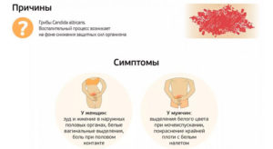 Причины и признаки молочницы у женщин