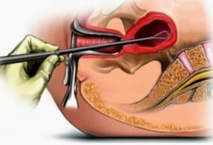 Диагностическое выскабливание полости матки при миоме