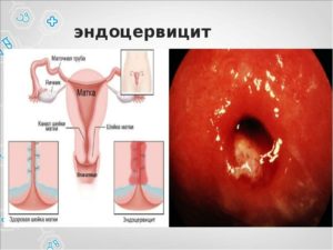 Симптомы воспаления цервикального канала