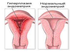 Что такое гиперплазия шейки матки