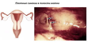 Беременность и синехии в матке
