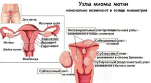 Узловая фибромиома матки