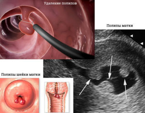 Полип в цервикальном канале шейки матки