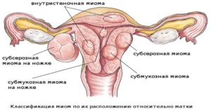 Киста и миома в чем разница