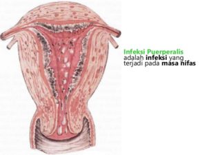 Что такое эндометрит матки
