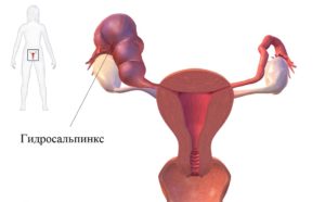 Гидросальпинкс при беременности