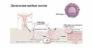 Дисплазия 1 степени шейки матки что это