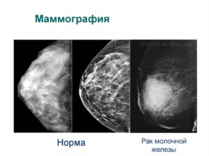 На какой день цикла делать маммографию