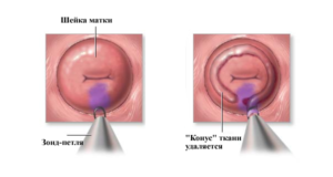 Что значит коническая шейка матки