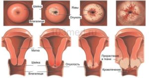 Рак шейки матки 2 стадии