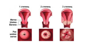 Как быстро происходит развитие рака шейки матки