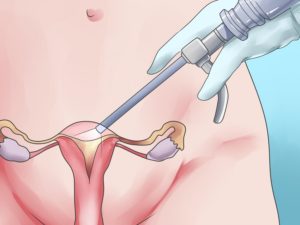 Операция по удалению эндометриоза матки