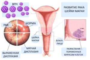 Симптомы и лечение папилломы матки