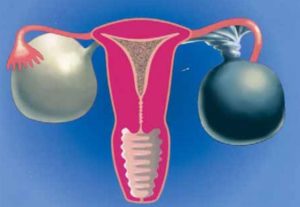 Перекрут яичника у женщин симптомы