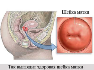 Что означает чистая шейка матки