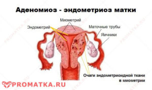 Как лечить народными средствами аденомиоз матки