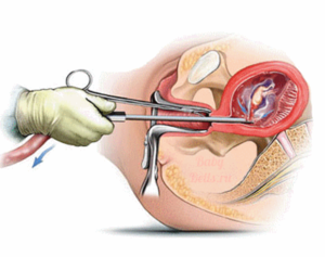 Половая жизнь после выскабливания