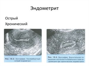 Что такое острый и подострый эндометрит